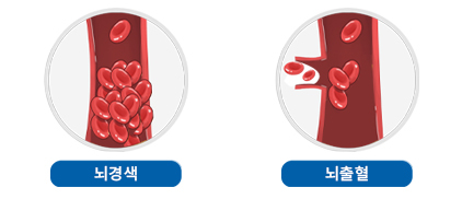 뇌졸중 이미지